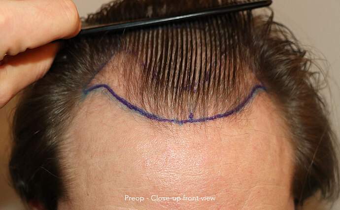 Case performed by Dr. Feriduni – 3322 FU in 1 procedure photo
