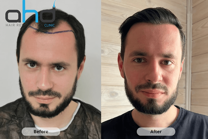 AHD Clinic / Dr.Hakan Doganay's Team / 4300 grafts / DHI + FUE photo