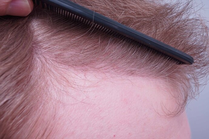 Dr B Farjo 1820 FUE (Fontal) Very early growth. photo