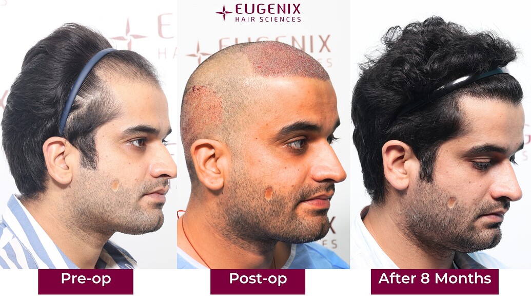 https://cdn.forumhairtransplant.com/optimized/3X/c/e/ce1476c2a672d5f3a1da4882cb1254c0e31fd399_2_1035x582.jpeg