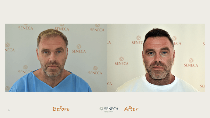 Seneca Medical Group - 2300 grafts with Direct Fue photo