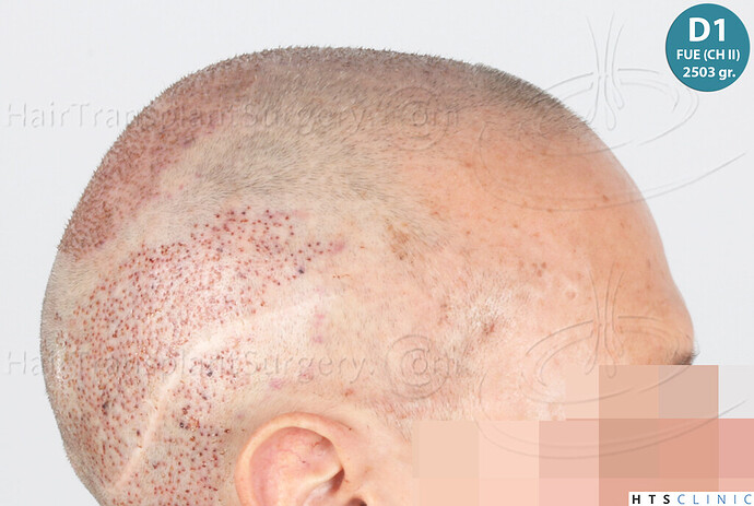 Dr Devroye + Dr Montesanti + Dr Jenard / 7015 grafts (4512 FUT + 2503 FUE) / 2 sessions photo