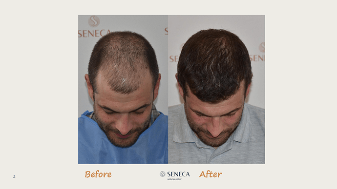 Seneca Medical Group - 2308 grafts with Direct Fue photo