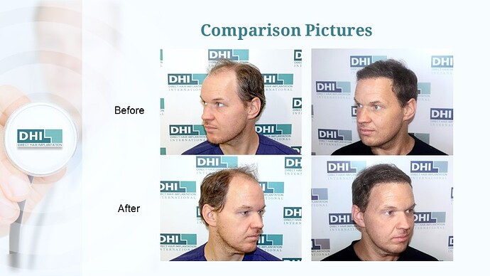 DHI India™ | NW 6 | 2,507 Grafts | 4 Months Hair Transplant Results photo