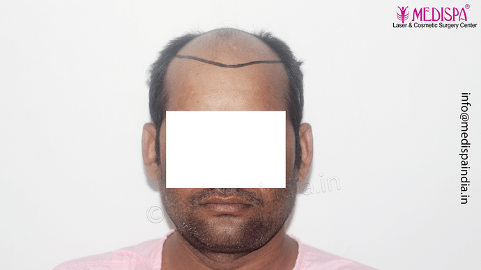 Dr. Suneet Soni - 4992 Grafts | 12-Month Result | Combination FUT + FUE + Beard photo