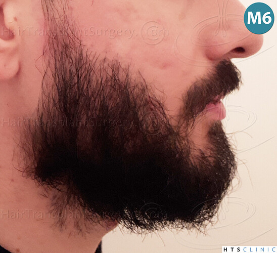 Dr. Jean Devroye, HTS Clinic / 1523 FUE / Beard to beard restoration photo