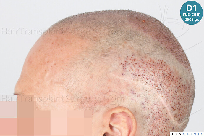 Dr Devroye + Dr Montesanti + Dr Jenard / 7015 grafts (4512 FUT + 2503 FUE) / 2 sessions photo