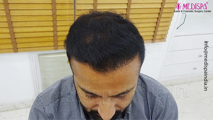 Dr. Suneet Soni - 5334 Grafts, Combine FUT + FUE + BHT (Beard) Technique, NW- V photo