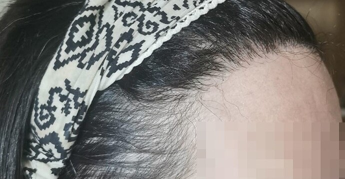 Dr. Bisanga, BHR Clinic, 2000 FUE / 0-8 Months - Female Case photo