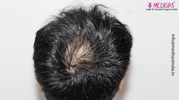 Dr. Suneet Soni - 4889 Grafts | 2.5 Years Result | Combination FUT + FUE + Beard photo