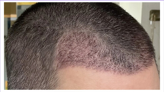 Dr. Bisanga + Dr. Kostis - BHR Clinic - 2176 FUE - 0 - 5 Months photo