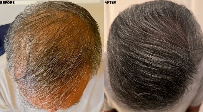 AlviArmani new FUE result 3,500 grafts - Dr. Hughes photo