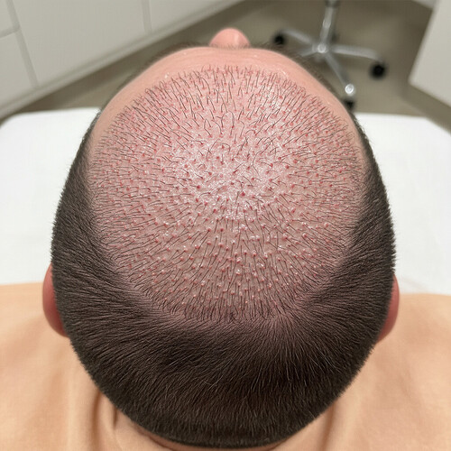 The Critical First 48 Hours After Hair Transplant: Avoiding Trauma for Optimal Healing