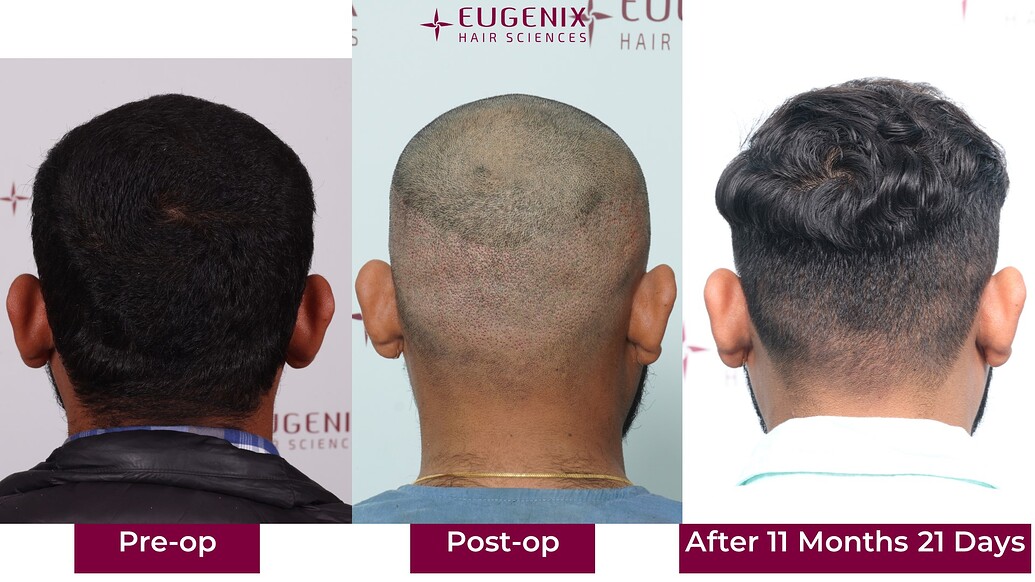 https://cdn.forumhairtransplant.com/optimized/3X/c/f/cf75bf2ea924c9349149511d0003ddd071dbd0e5_2_1035x582.jpeg