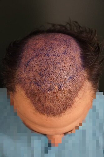 Hattingen Hair Clinic, 4 435: 4 093 FUT and 342 FUE. photo