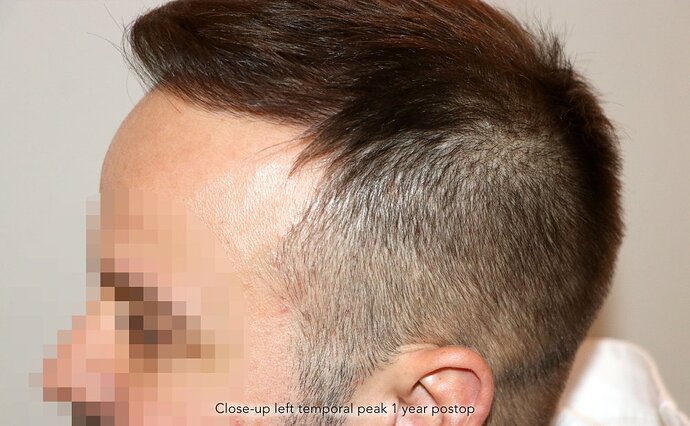 Case performed by Dr. Feriduni – 3726 FU in 1 procedure photo