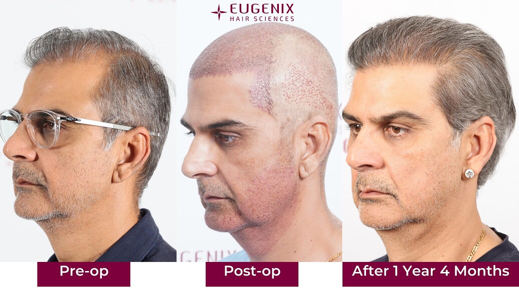 https://cdn.forumhairtransplant.com/optimized/3X/c/f/cfc72a708b24fe109b55185a49a7829a1bd910eb_2_1035x582.jpeg