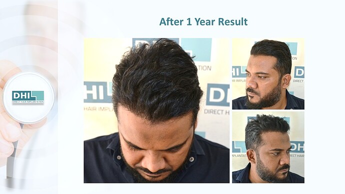 DHI India™ | NW 3 | 4,821 Grafts | 1 year DHI Hair Transplant Results photo