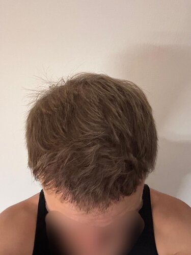 Ozlem Bicer MD-Hair Transplant-2720 Grafts FUE by micro-motor, 9. months result photo
