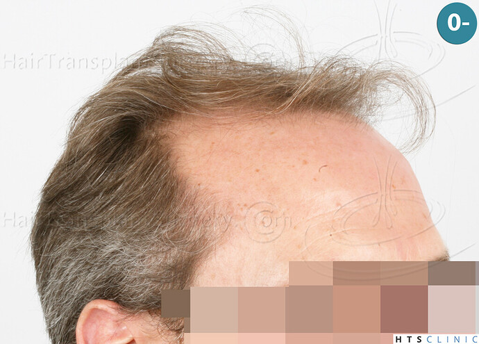 Dr Devroye + Dr Montesanti + Dr Jenard / 7015 grafts (4512 FUT + 2503 FUE) / 2 sessions photo