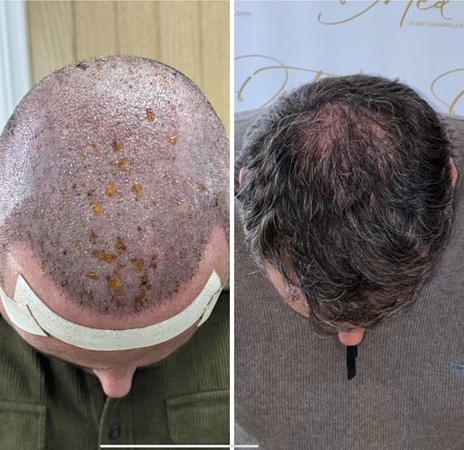 Dr Ted Miln (UK) | 6,120 grafts | FUT+FUE combo | Hairline, midscalp & crown restoration | 8.5 months post-op photo