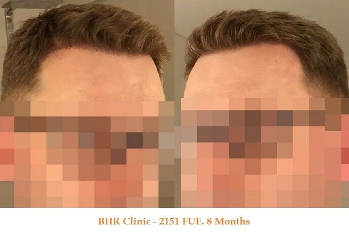 Dr. Bisanga, BHR Clinic. 2151 FUE. 0-8 Months photo