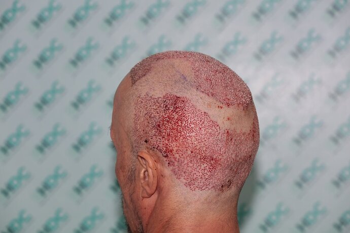 Hair Transplant Outcome with 4000 Grafts Across NW5 Zone – HDC Hair Clinic photo