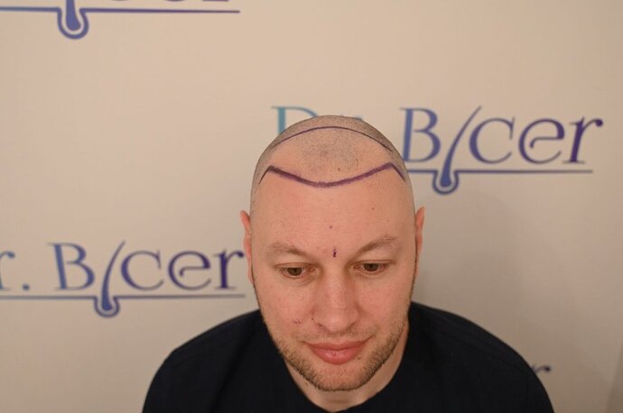 Ozlem Bicer MD-Hair Transplant-2910 Grafts FUE by micro-motor, 7. months result photo
