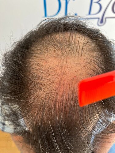Ozlem Bicer MD-Hair Transplant-3890 Grafts FUE by micro-motor, 12. months result photo