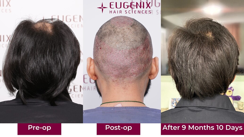 https://cdn.forumhairtransplant.com/optimized/3X/d/1/d1217acc4e927550c9de6f7d5673958235d5d670_2_1035x582.jpeg