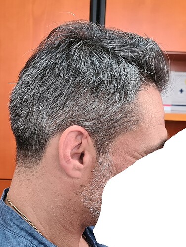 Enhancement of density to top and crown with 2900 Grafts only – HDC Hair Clinic photo