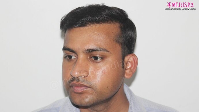 Dr. Suneet Soni - 5587 Grafts, Combine FUT + FUE + Beard Technique, NW : V-VI photo