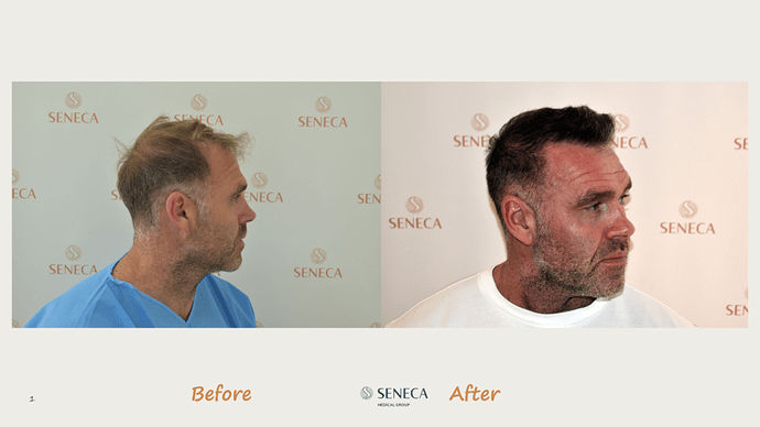 Seneca Medical Group - 2300 grafts with Direct Fue photo