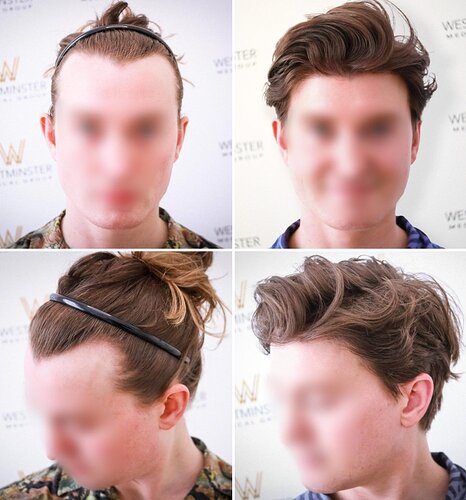 Westminster Medical Group London - 1562 Grafts - 12 Months Progress photo