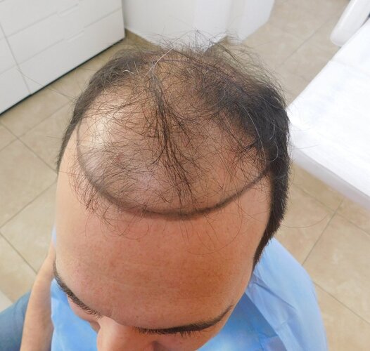 HDC Hair Clinic – FUE Hair Transplant Result for 4534 Grafts photo