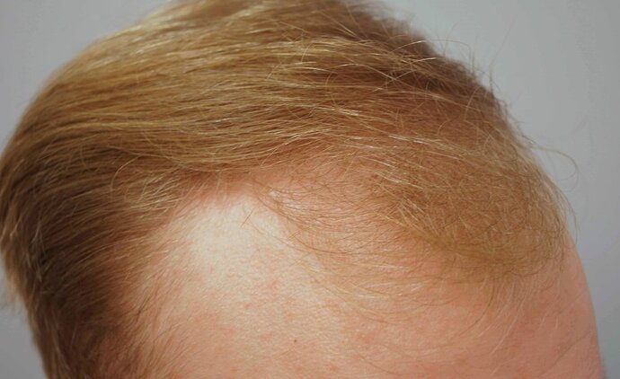Dr B Farjo 1820 FUE (Fontal) Very early growth. photo