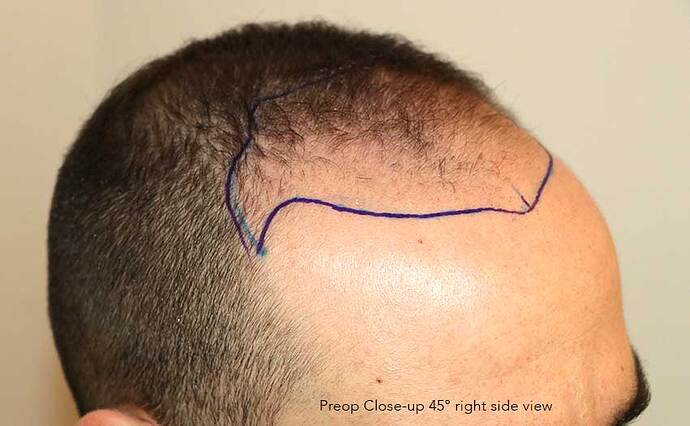 Case performed by Dr. Feriduni – 3505 FU in 1 procedure photo