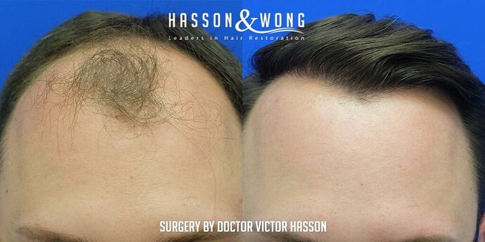 Dr. Hasson / 4,511 grafts / FUE / Frontal zone /mid / 3 years post-op photo