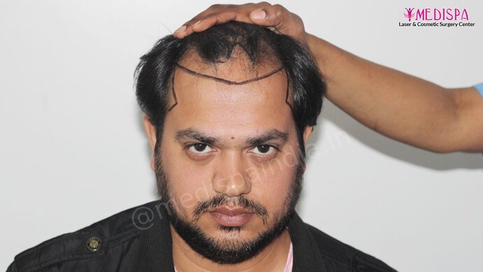 Dr. Suneet Soni - 4937 Grafts, Combine FUT + FUE Technique, NW : IV-V photo