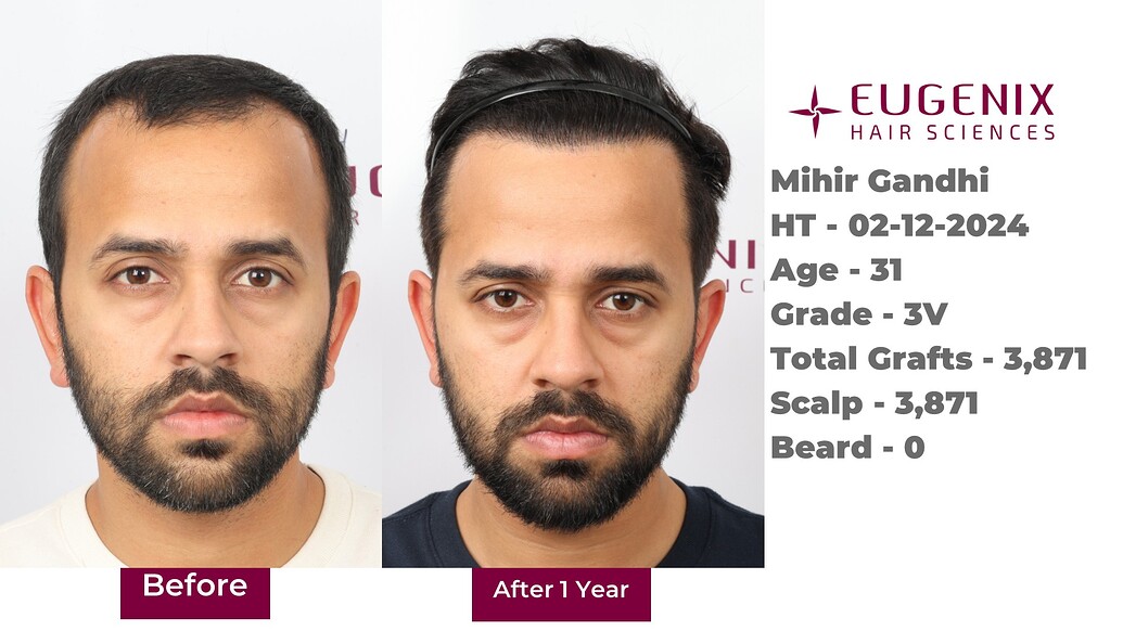 https://cdn.forumhairtransplant.com/optimized/3X/d/2/d2b05f245358494f92241c252eb93a61793137a8_2_1035x582.jpeg