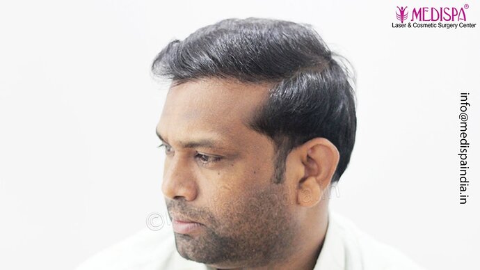 Dr. Suneet Soni - 5498 Grafts, 2 Years Result, Combine FUT + FUE + Beard Technique, NW-VI photo