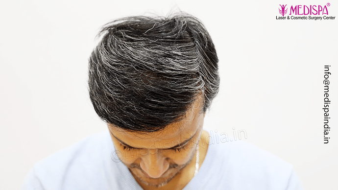Dr. Suneet Soni - 4889 Grafts | 2.5 Years Result | Combination FUT + FUE + Beard photo