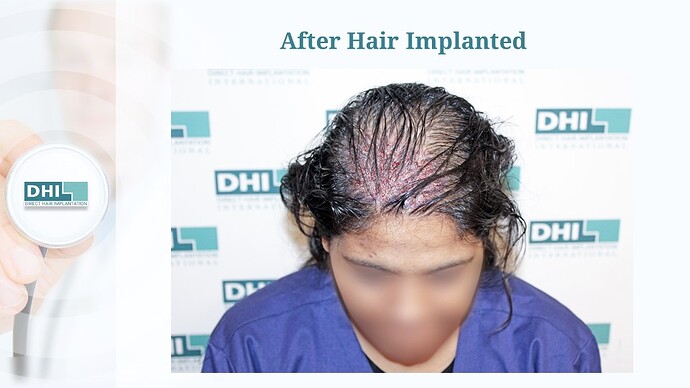 Female Hair Transplant | 1,359 Grafts | 6-Months Result | DHI India™ photo