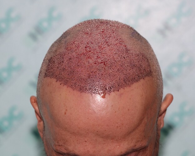 Hair Transplant Outcome with 4000 Grafts Across NW5 Zone – HDC Hair Clinic photo