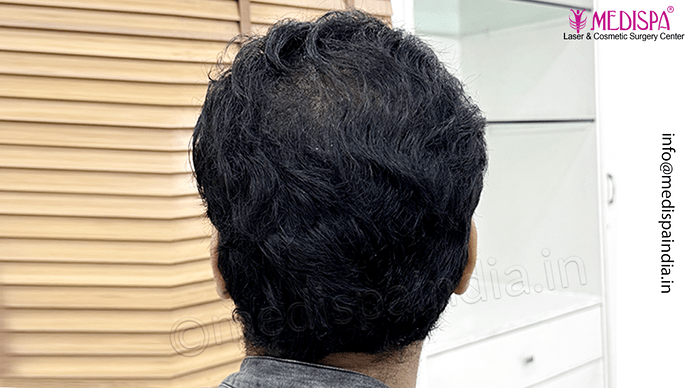 Dr. Suneet Soni - 5467 Grafts, Combine FUT + FUE + Beard Technique, NW- V, 3 Years Result photo