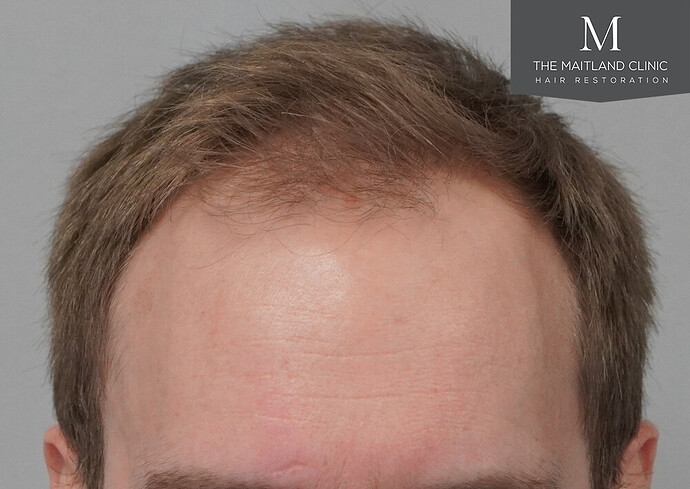 1826 grafts by FUE with Dr Edward Maitland Ball at The Maitland Clinic photo
