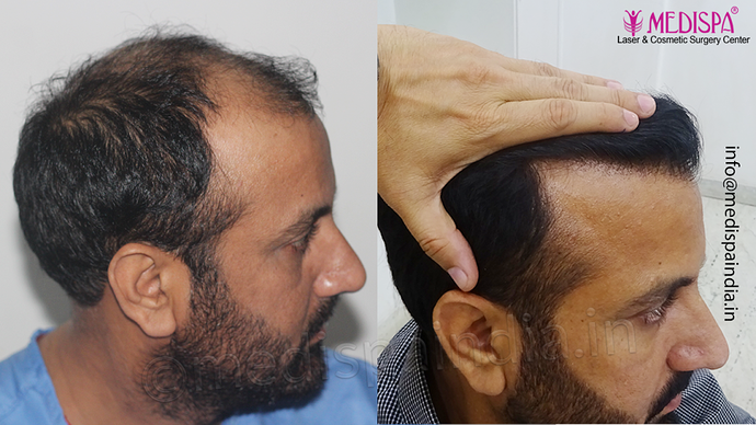 Dr. Suneet Soni - 5334 Grafts, Combine FUT + FUE + BHT (Beard) Technique, NW- V photo