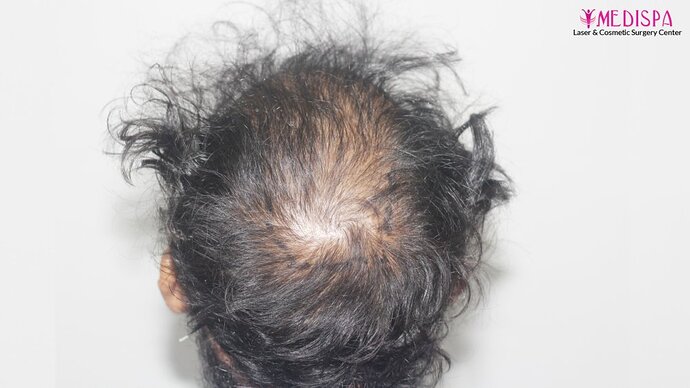 Revision Hair Transplant - 5111 Grafts / 5 Years Result - Dr. Suneet Soni, Medispa India photo