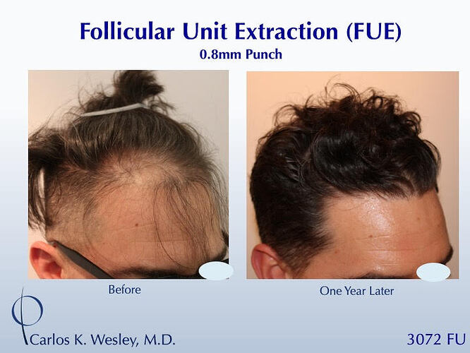 #BAM Natural-Appearing FUE Hairline Wavy Hair (3072 grafts): Carlos K. Wesley, M.D. (NYC & LA) photo