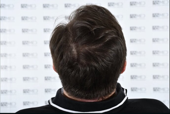 ASMED CLINIC - DR.KORAY - 5060 GRAFTS FUE photo